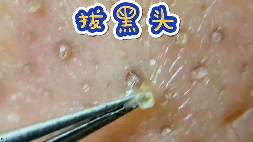 夹黑头粉刺视频,视频揭秘高效清洁秘诀